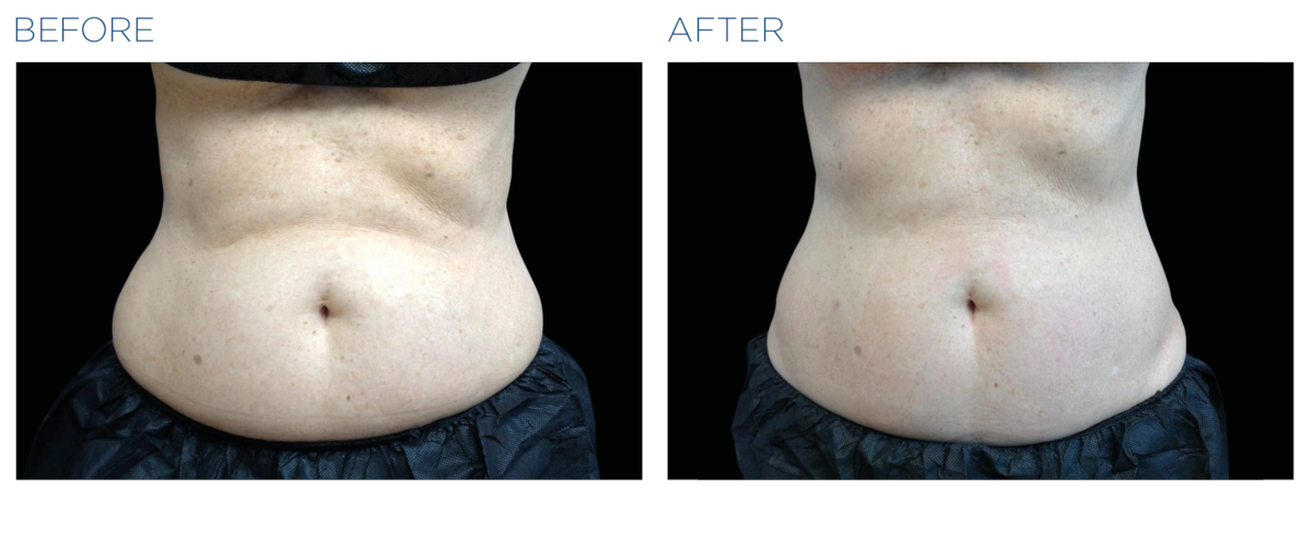 A woman's stomach before and after getting Emsculpt NEO for noninvasive fat removal near Bucktown.