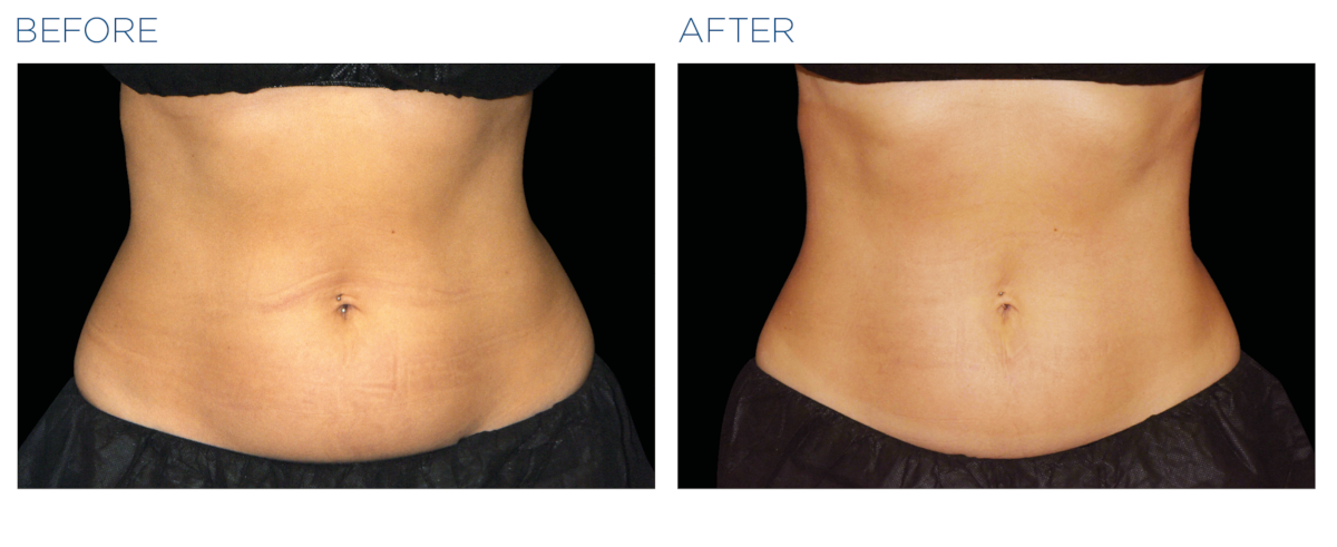 A woman's stomach before and after getting Emsculpt NEO for noninvasive fat removal near Bucktown.