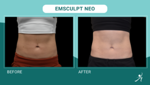 Emsculpt Neo in Chicago