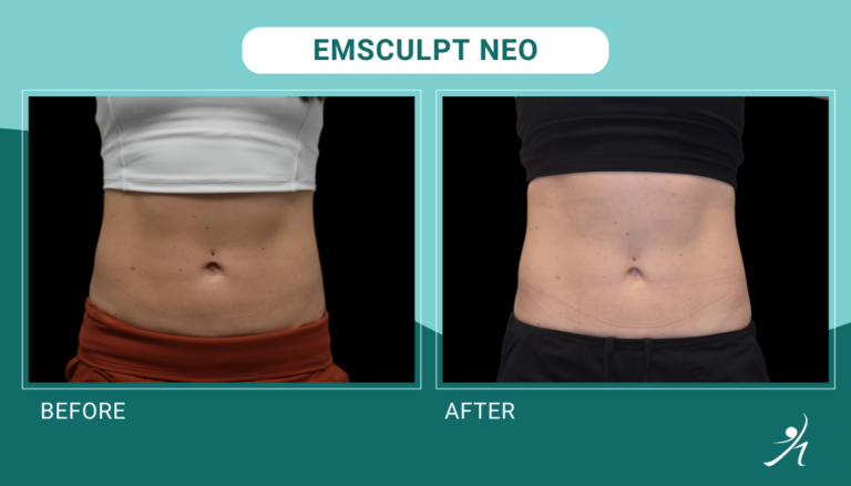 Emsculpt Neo in Chicago