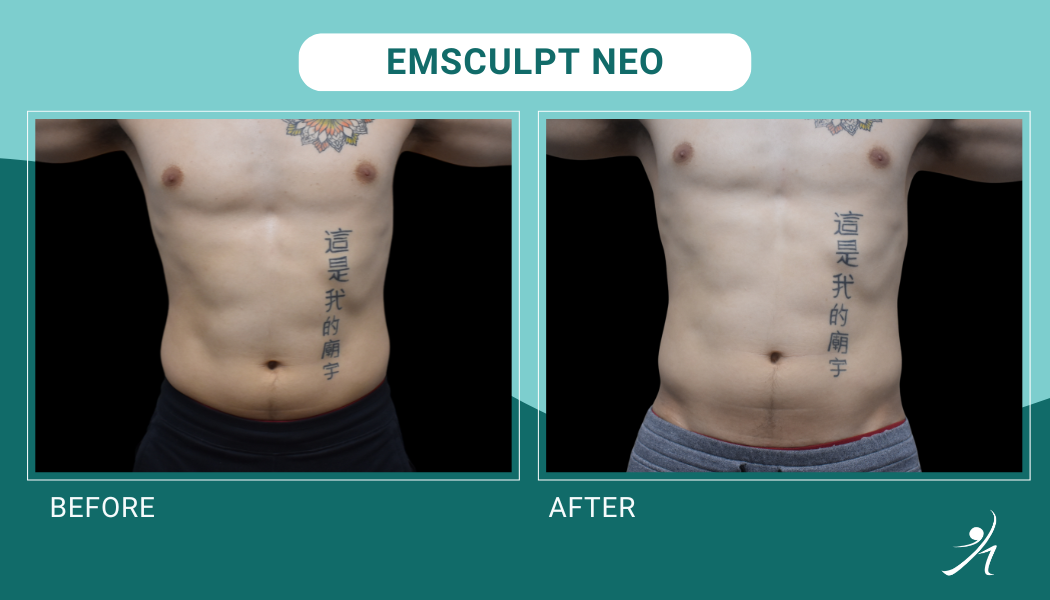 Emsculpt Neo in Chicago