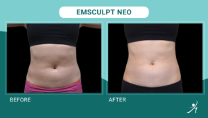 Emsculpt Neo in Chicago