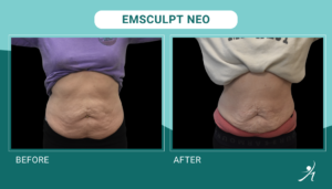 Emsculpt Neo in Chicago