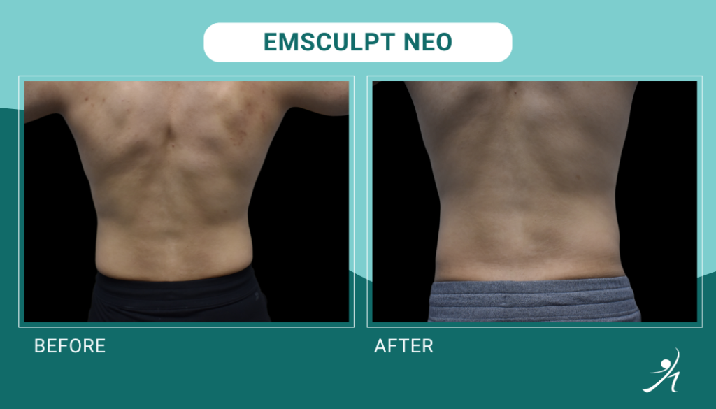 Emsculpt Neo in Chicago