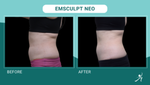 Emsculpt Neo in Chicago