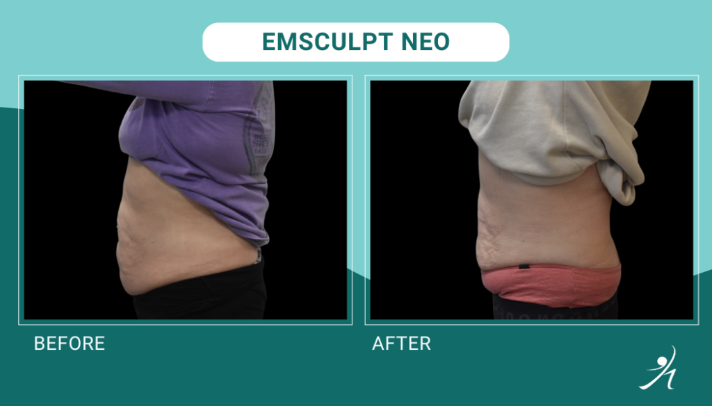 Emsculpt Neo in Chicago