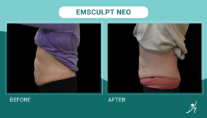 Emsculpt Neo in Chicago