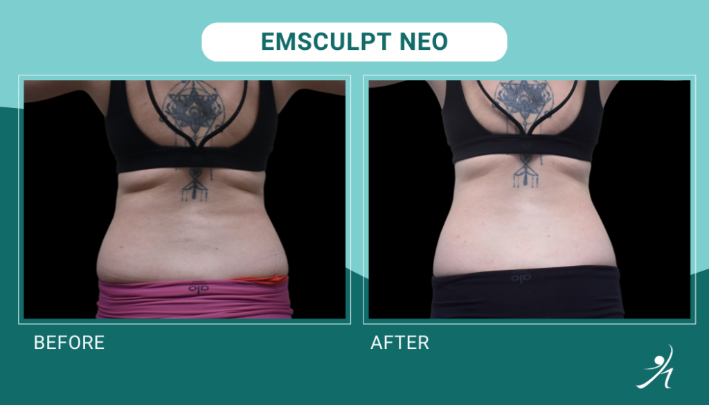 Emsculpt Neo in Chicago