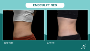 Emsculpt Neo in Chicago