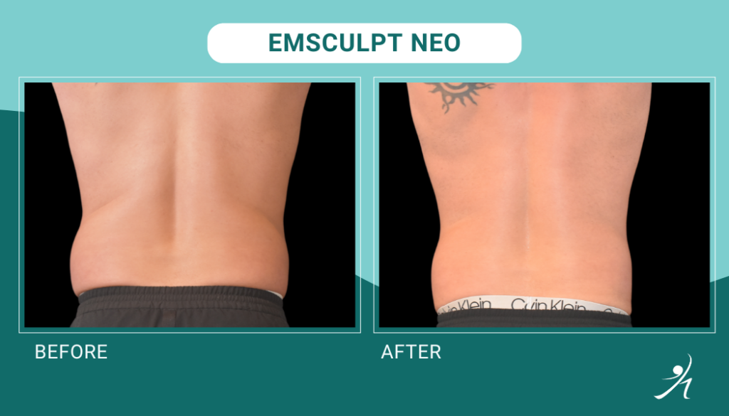 Emsculpt neo chicago before and after