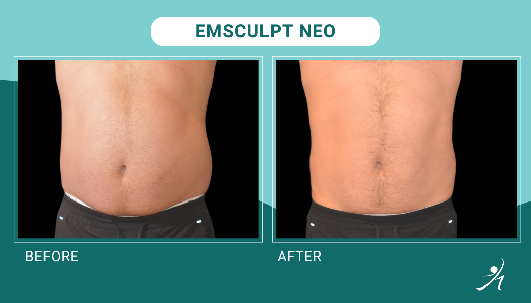 Emsculpt neo chicago before and after