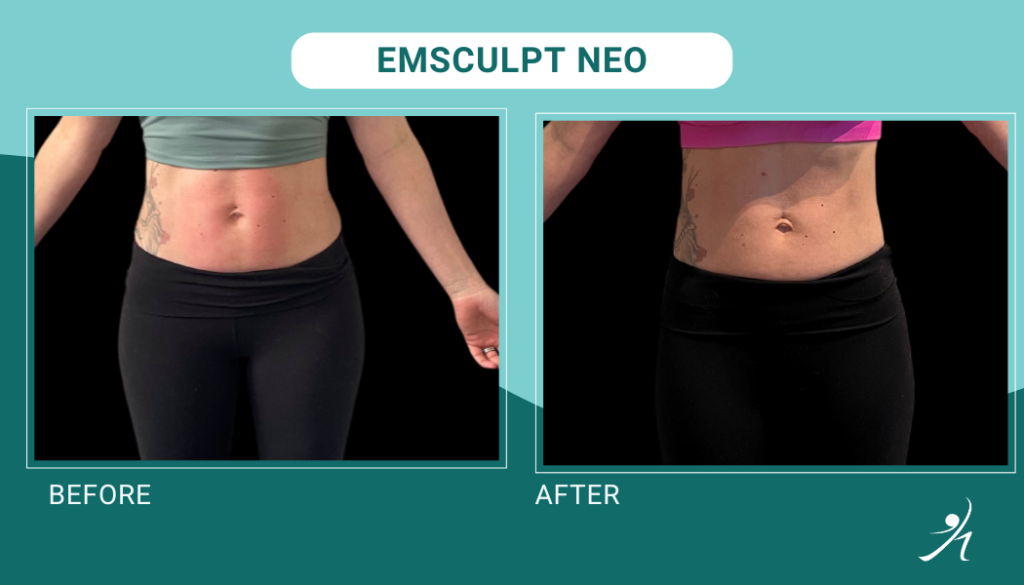 Emsculpt neo chicago before and after