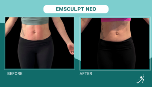 Emsculpt neo chicago before and after