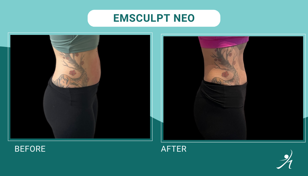 Emsculpt neo chicago before and after