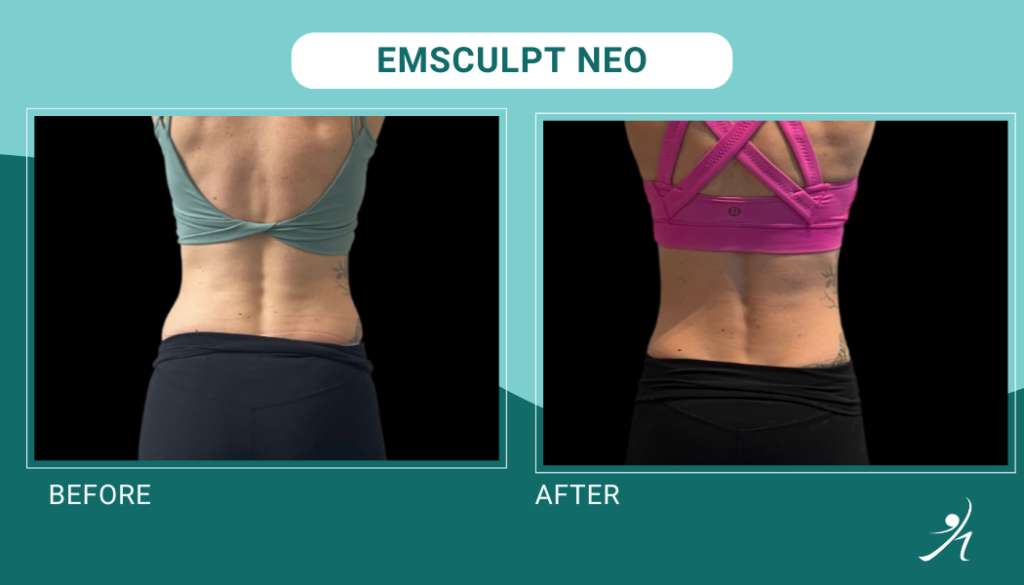Emsculpt neo chicago before and after